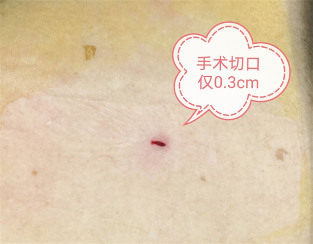 脊柱微创快速康复，助力百岁人生！3.jpg
