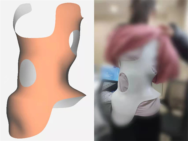3D打印技术引领，脊柱外科在复杂颈椎手术精准治疗领域迈上新台阶！4.jpg