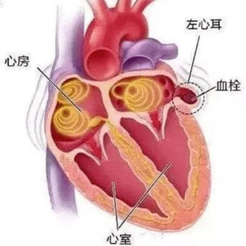 【新技术】心血管内科成功开展房颤射频消融+左心耳封堵一站式手术4.jpg