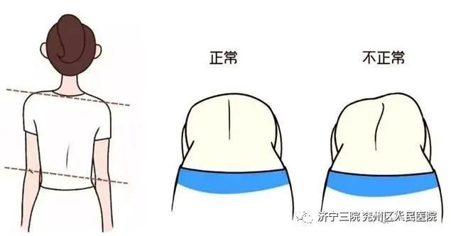 关注青少年脊柱健康！寒假期间康复治疗八折优惠不容错过！2.jpg
