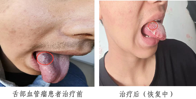告别“红色印记”，超声导航精准治疗血管瘤3.jpg